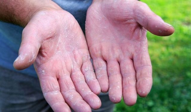 Mevsim Değişimi Demek Egzama Demek: Cildinizi Korumanın Yolları